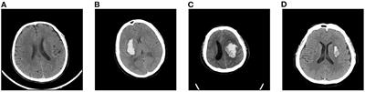 Prior knowledge-based precise diagnosis of blend sign from head computed tomography